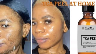 HOW TO DO A CHEMICAL PEEL AT HOME TCA PEEL BEFORE amp AFTER PLURAL INFUSION [upl. by Yruoc]