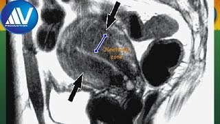 Adenomyosis part 2 [upl. by Nomahs]