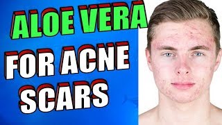 How To Use Aloe Vera OVERNIGHT To Treat Acne Scars Pimples amp Zits [upl. by Susejedairam]