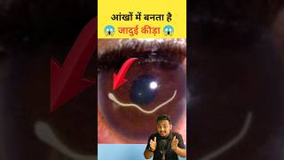 आंखों में बनता है जादुई कीड़ा 😳 l Eye Mucus Fishing Syndrome l shorts mucusfishing [upl. by Ellak]