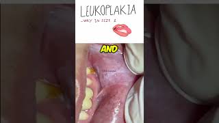 Oral Leukoplakia  Dentogenesis [upl. by Holey]