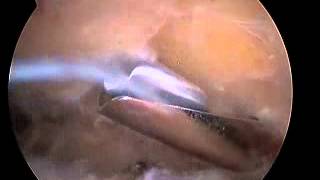 Arthroscopic Subacromial Decompression [upl. by Nivlad]