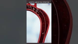 Aortic Dissection stenting medical video [upl. by Melvyn]