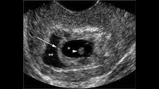 Haematoma surrounding gestational sac amp its significance [upl. by Romy722]