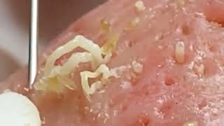 Blackheads amp Whiteheads Satisfying Removal 0078 [upl. by Redvers346]