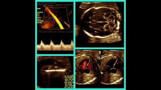 Evaluación completa de la Anatomía Fetal paso a paso [upl. by Sylvan689]