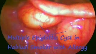 Laryngology  Multiple Epiglottic Cyst in Habiual Smoker with Allergy [upl. by Edmond]