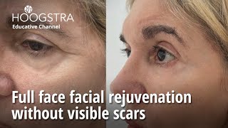 Full face facial rejuvenation without visible scars  24068 [upl. by Aztiram]