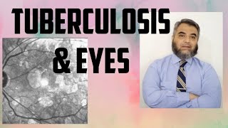 TUBERCULOSIS AND EYES Tuberculosis EyeinfectionRifampicinisoniazidethambutol [upl. by Hanaj408]