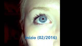 NISTAGMO CONGENITO CONGENITAL NYSTAGMUS [upl. by Ivers]