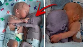 Mom puts the baby to the dying Twin and five minutes later a real Miracle happens [upl. by Nnairam]