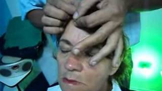 Acupuntura  Tratamento para sequela neurologica facial 4º sessãoCITE Dr Heitor Casadoavi [upl. by Eirrol]