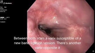 Oesophageal varices treated with band ligation [upl. by Kurtzman391]