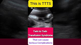 TTTS  Twin to Twin Transfusion Syndrome Ultrasound  Monochorionic TWINS [upl. by Otho]