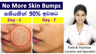 Best Treatment for Oily Skin Bumps with Scientific Explanation  Magical ResultsJust one ingredient [upl. by Lancaster]