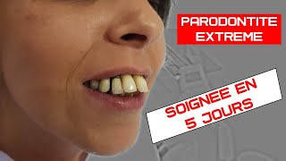 Soigner la parodontite avec perte de gencive  Implants dentaires basales non invasif [upl. by Jessamyn]