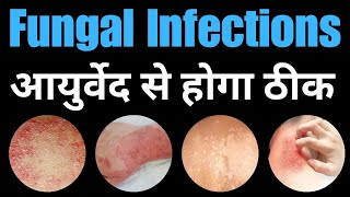 Prevent and Cure Fungal Infections with Ayurveda Symptoms amp Herbal Treatments [upl. by Petit938]