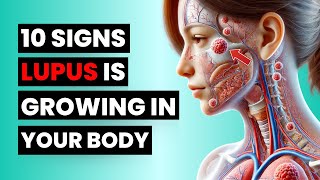 Dont Miss These 10 Early Lupus Signs – It Could Save You [upl. by Ahset413]