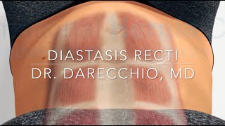 Does Diastasis Recti exercises really close the GAP  Dr Darecchio [upl. by Ak581]