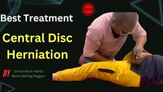 A Central Disc Herniation Is A Rare Condition  Disc Herniation Recovery [upl. by Reibaj231]