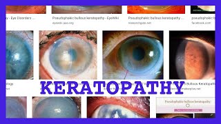 keratopathy [upl. by Ettenoitna801]