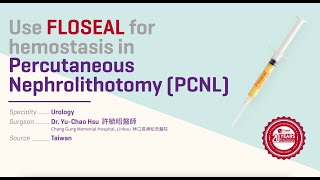 Use Floseal in Tubeless PCNL 伏血凝止血劑用於經皮腎造廔取石術 [upl. by Refiffej]