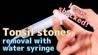 Tonsil stones removal with water syringe [upl. by Asilak]