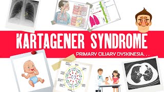 Kartagener syndrome Primary Ciliary Dyskinesia Immotile cilia syndrome triad mnemonic amp cause [upl. by Yboc]