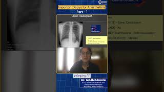 Important Xrays for Anesthetists by Dr Siddhi Chawla [upl. by Yeldua]