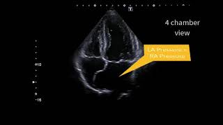 Atrial septal aneurysm [upl. by Namia]