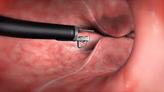 What Happens During the Endoscopic Sleeve Gastroplasty ESG Procedure [upl. by Reibaj]