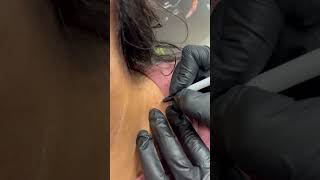 Treating a Skin Tag More Flush to the Skin [upl. by Goldy]