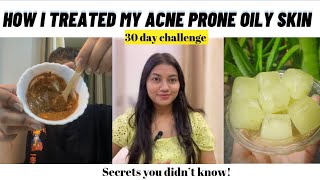 Oily and Acne Prone skincare  Honest and Practical routine Home remedies  Pragya Arya [upl. by Yrtua]