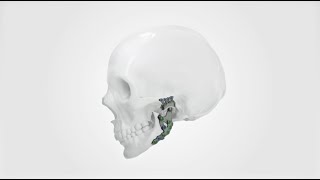 IPS Implants® TMJ Prosthesis [upl. by Nnyleak]