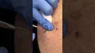 Satisfying DPOW Removal shorts dpow pimplepoppers dermatologist [upl. by Ahsaercal]