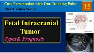 Fetus Ultrasound  Fetal Intracranial Tumor [upl. by Ahc792]