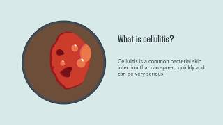 Cellulitis Causes Symptoms Diagnosis and Treatment  Merck Manual Consumer Version Quick Facts [upl. by Weiser609]