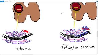 Systemic pathology 30  Endocrine 3  thyroid tumors  DRSAMEH GHAZY [upl. by Arimahs]