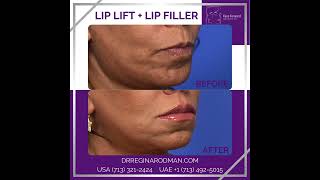 Lip Lift  Filler [upl. by Ardnosak705]