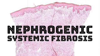 Nephrogenic systemic fibrosis from Gadolinium MRI contrast pathology dermatology dermatopathology [upl. by Aronek]