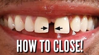 Orthodontic closing springs Diastema lesson [upl. by Drahsir]