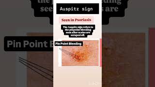 AUSPITZ SIGN  PSORIASIS  Day 4 of clinical learnings aiapget shorts viralshort neetpg [upl. by Nylteak]