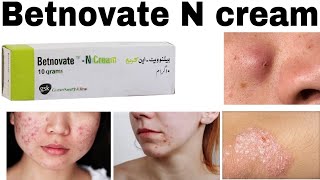 Betnovate n Skin care Cream How to use Benefits amp Side effects [upl. by Hammerskjold]