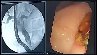 ERCP Stone Extraction Mechanical Lithotripsy and Plastic Stent Placement BDENDOSCOPY [upl. by Merlina]