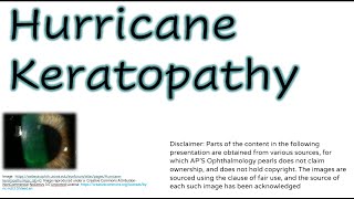 Hurricane Keratopathy [upl. by Tini757]