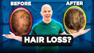 Oral Minoxidil For Hair Loss What You Need to Know [upl. by Adnaluoy]