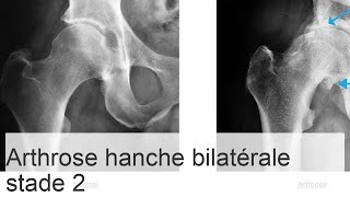 Coxarthrose bilatérale de stade 2  causes symptômes de la maladie méthodes de thérapie [upl. by Valli]