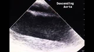 Which one is aorta in dissection to drahmadmirdamadisiXSy18xPgyiZ4mObV [upl. by Yedok]