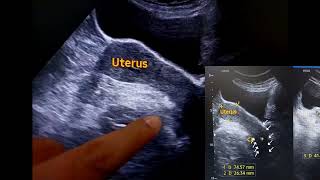 Prolapsed uterus gradeII in usg [upl. by Hairym]