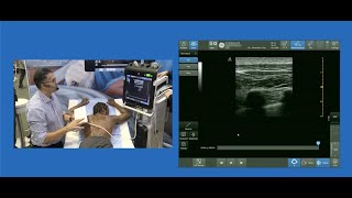 Paramedian Sagittal Approach to Thoracic Paravertebral Block [upl. by Ver]